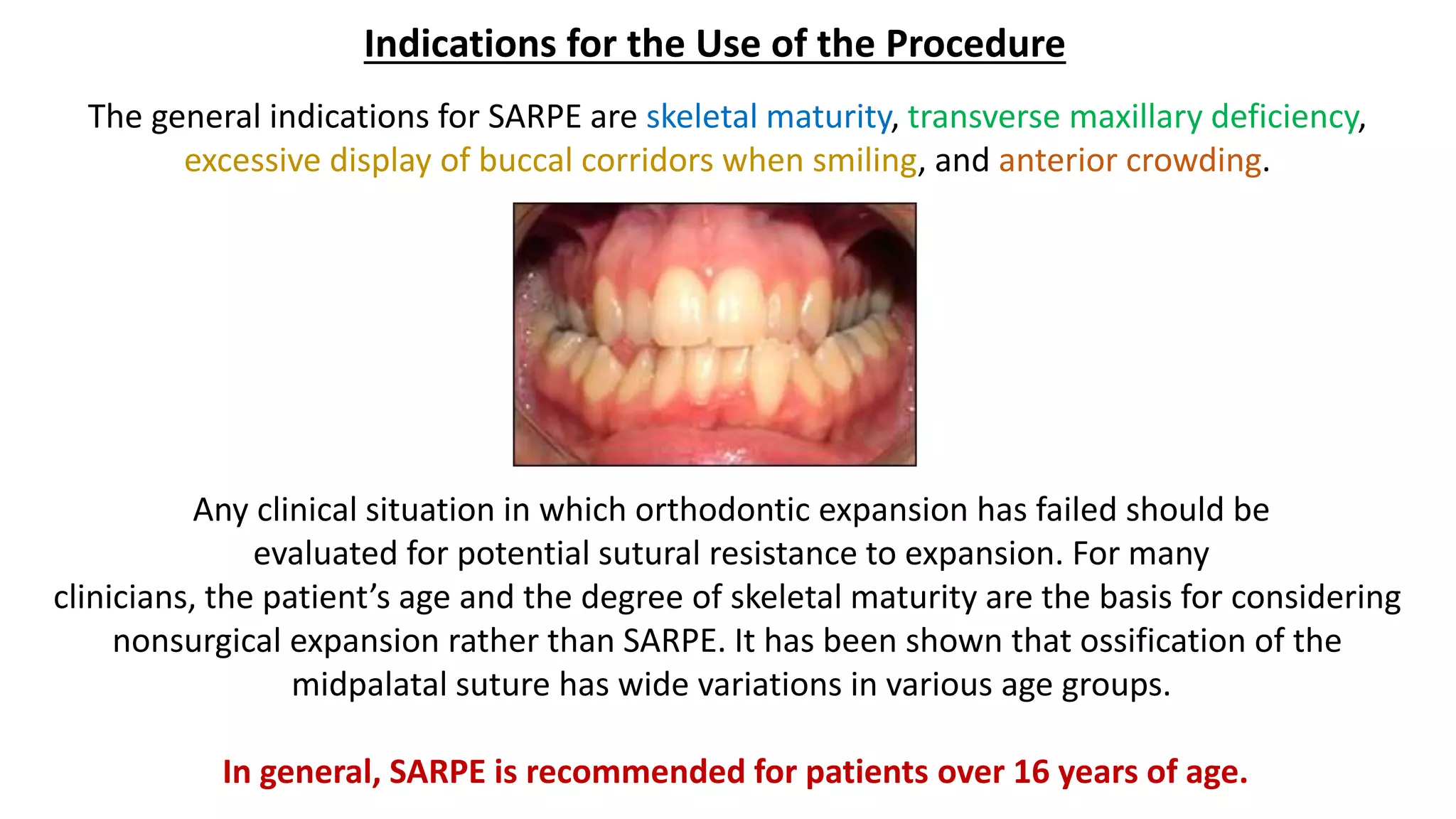 Surgically Assisted Rapid Palatal Expansion (SARPE) | PPTX