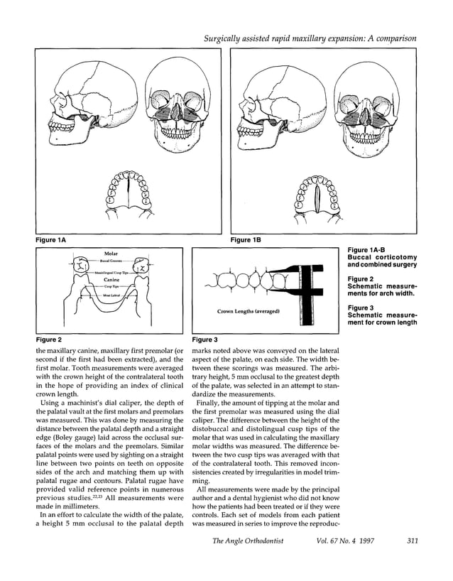 Surgically assisted rapid palatal expansion a comparison of technique ...