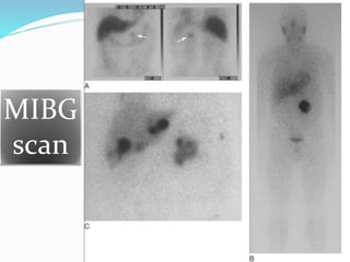 MIBG
scan
 