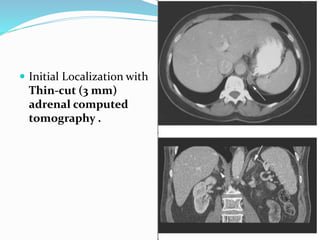  Initial Localization with
Thin-cut (3 mm)
adrenal computed
tomography .
 