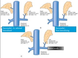 Successful , Lt. adrenal
lateralized
Successful ,
Non lateralizing
Failed study
 