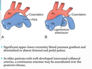  Significant upper-lower extremity blood pressure gradient and
diminished or absent femoral and pedal pulses.
 In older patients with well-developed intercostal collateral
arteries, a continuous murmur may be auscultated over the
posterior thorax.
 