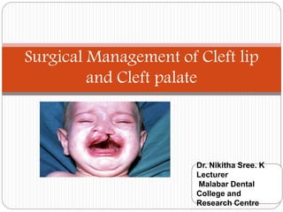 Surgical Management of Cleft lip
and Cleft palate
Dr. Nikitha Sree. K
Lecturer
Malabar Dental
College and
Research Centre
 