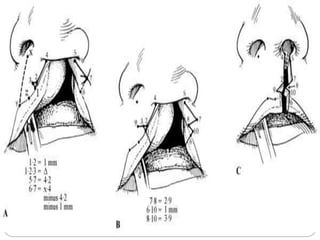 Surgical management cleft lip and palate | PPTX
