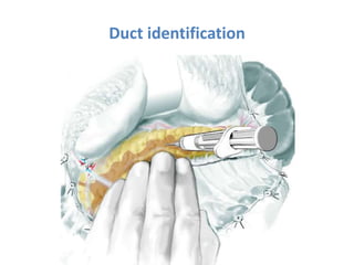 Surgical management of chronic pancreatitis. | PPTX
