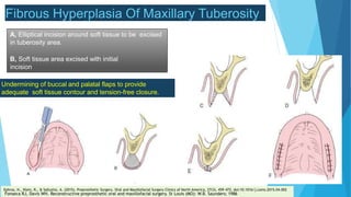 Elliptical Incisional SURGICAL MANAGEMENT OF COMPLETE DENTURE PATIENT | PPTX