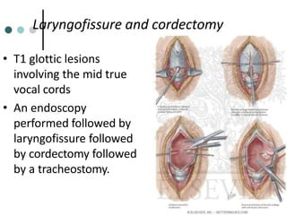 Cordectomy Surgical management of early laryngeal cancer dr.bhavin | PPTX