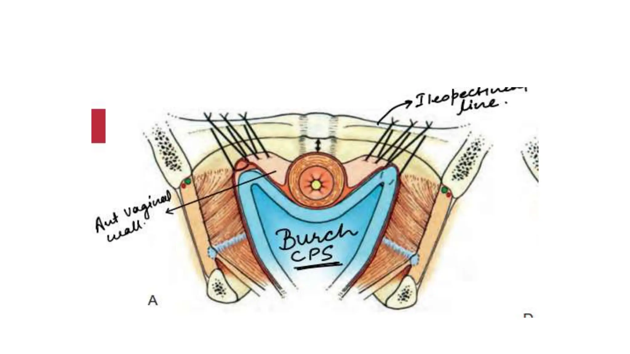 Surgical management of female stress urinary incontinence.pptx