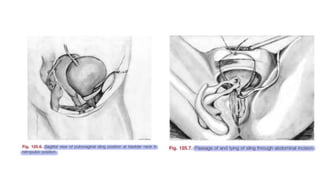 Surgical management of female stress urinary incontinence.pptx