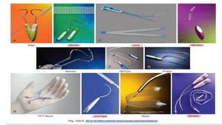 Surgical management of female stress urinary incontinence.pptx