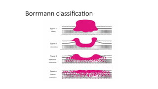 Boreman Classification surgical management of gastric cancer.pptx