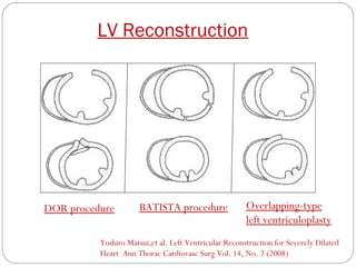 Surgical management of heart failure | PPT