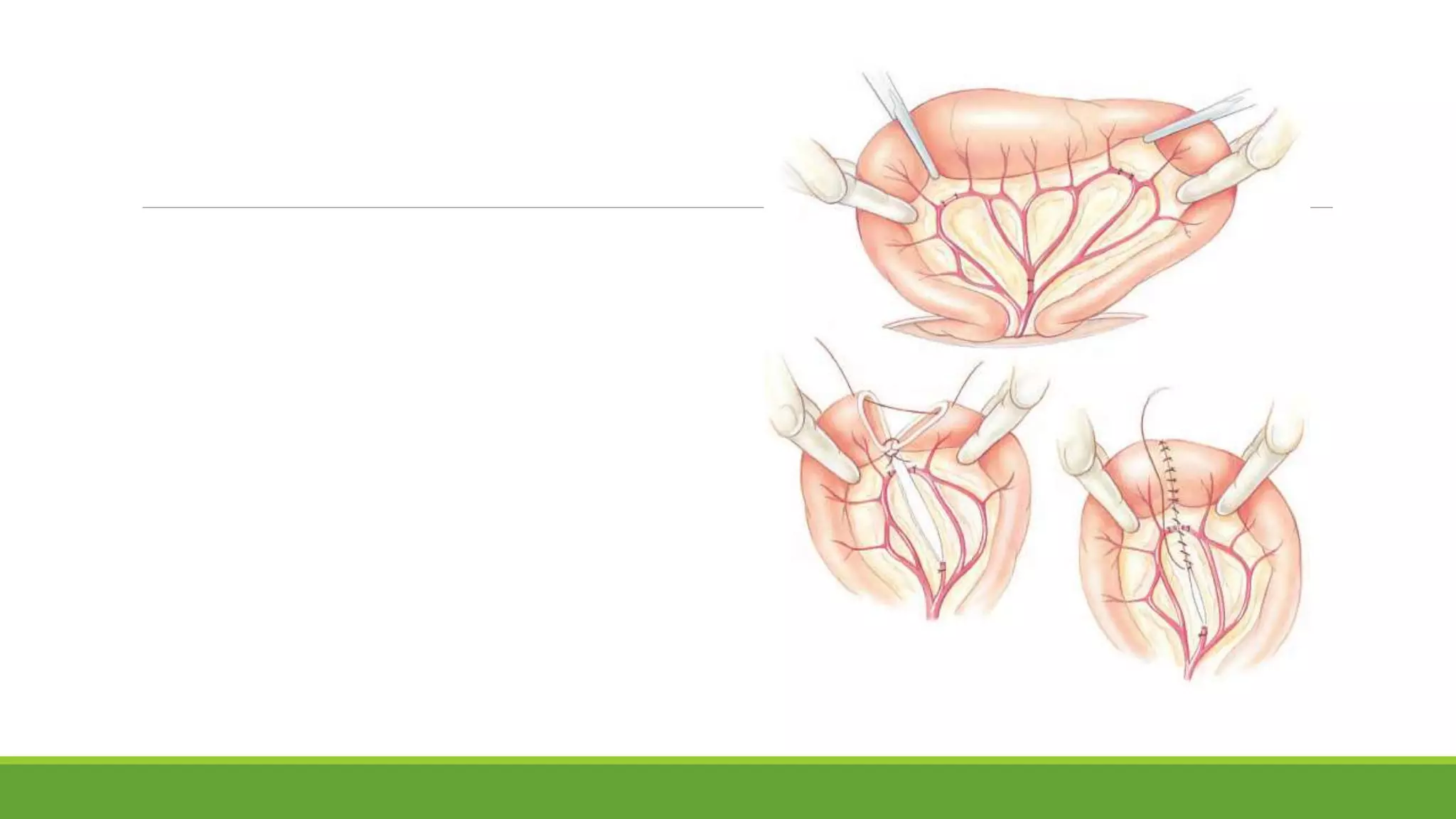 Intussusception In Dogs Surgical management of intussusception in a German Shepherd | PPTX