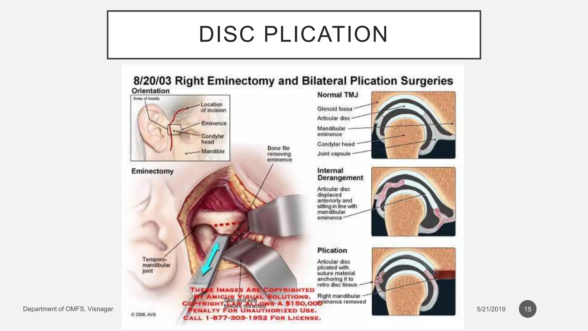 Journal Club on Surgical management of recurrent dislocation of tmj ...