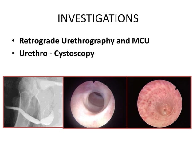 Surgical management of urethral stricture | PPTX | Sexual Conditions ...