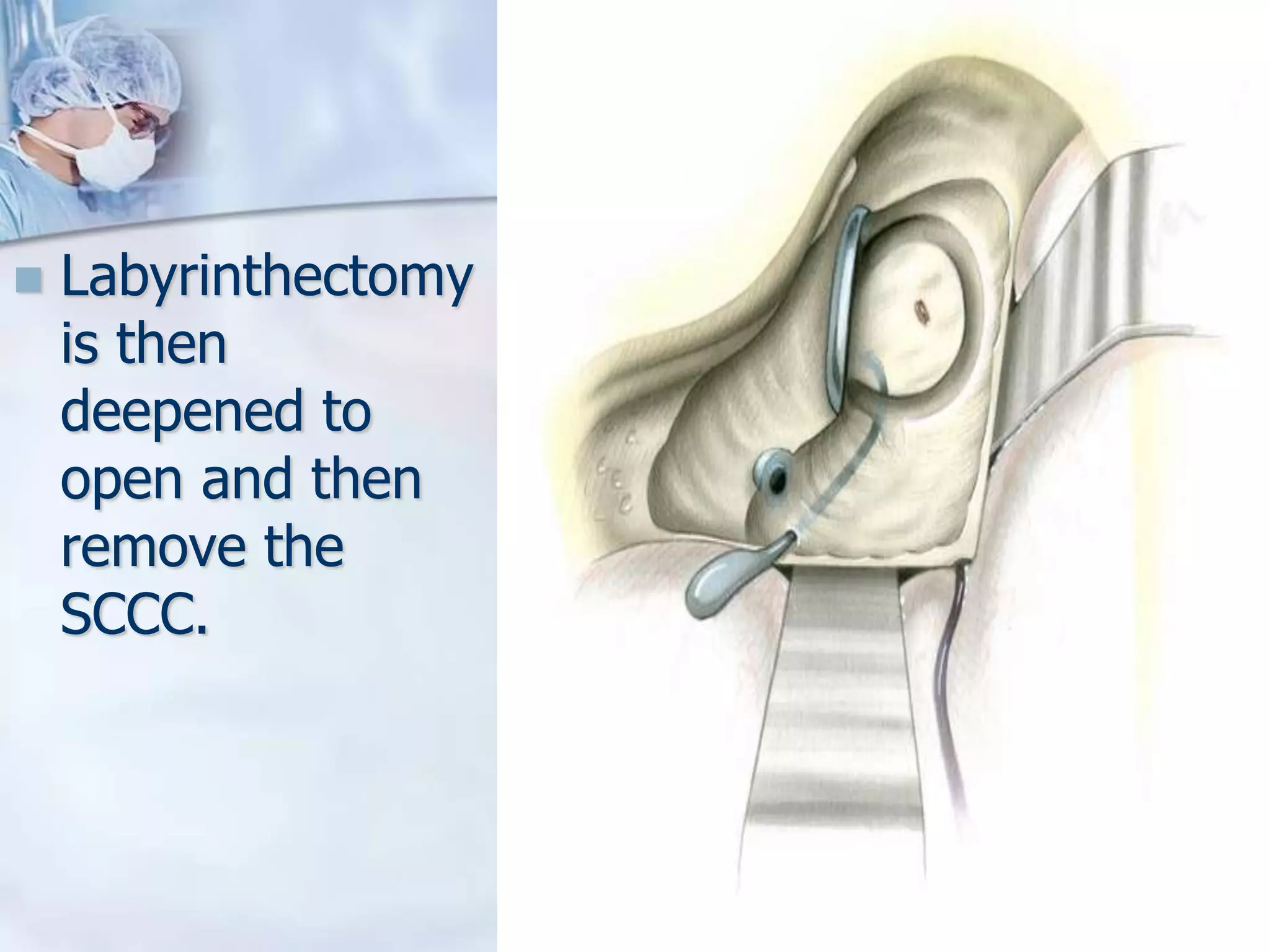 Surgical management of vestibular schwannoma by drdhiru456 | PPTX