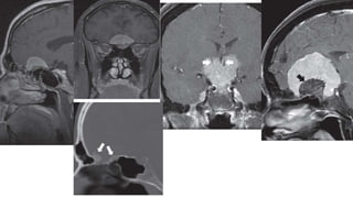 Surgical managment of anterior skull base meningeoma | PPTX