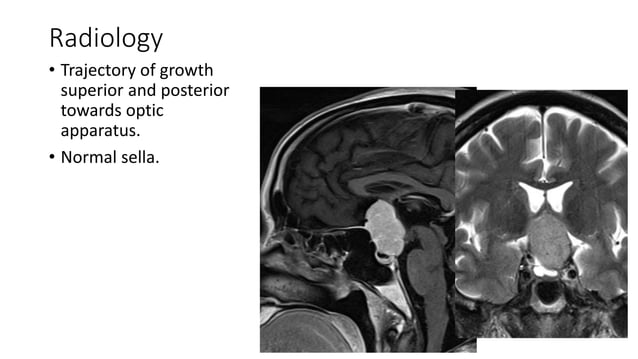 Surgical managment of anterior skull base meningeoma | PPT
