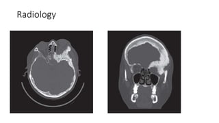 Surgical managment of anterior skull base meningeoma | PPTX