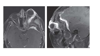 Surgical managment of anterior skull base meningeoma | PPTX