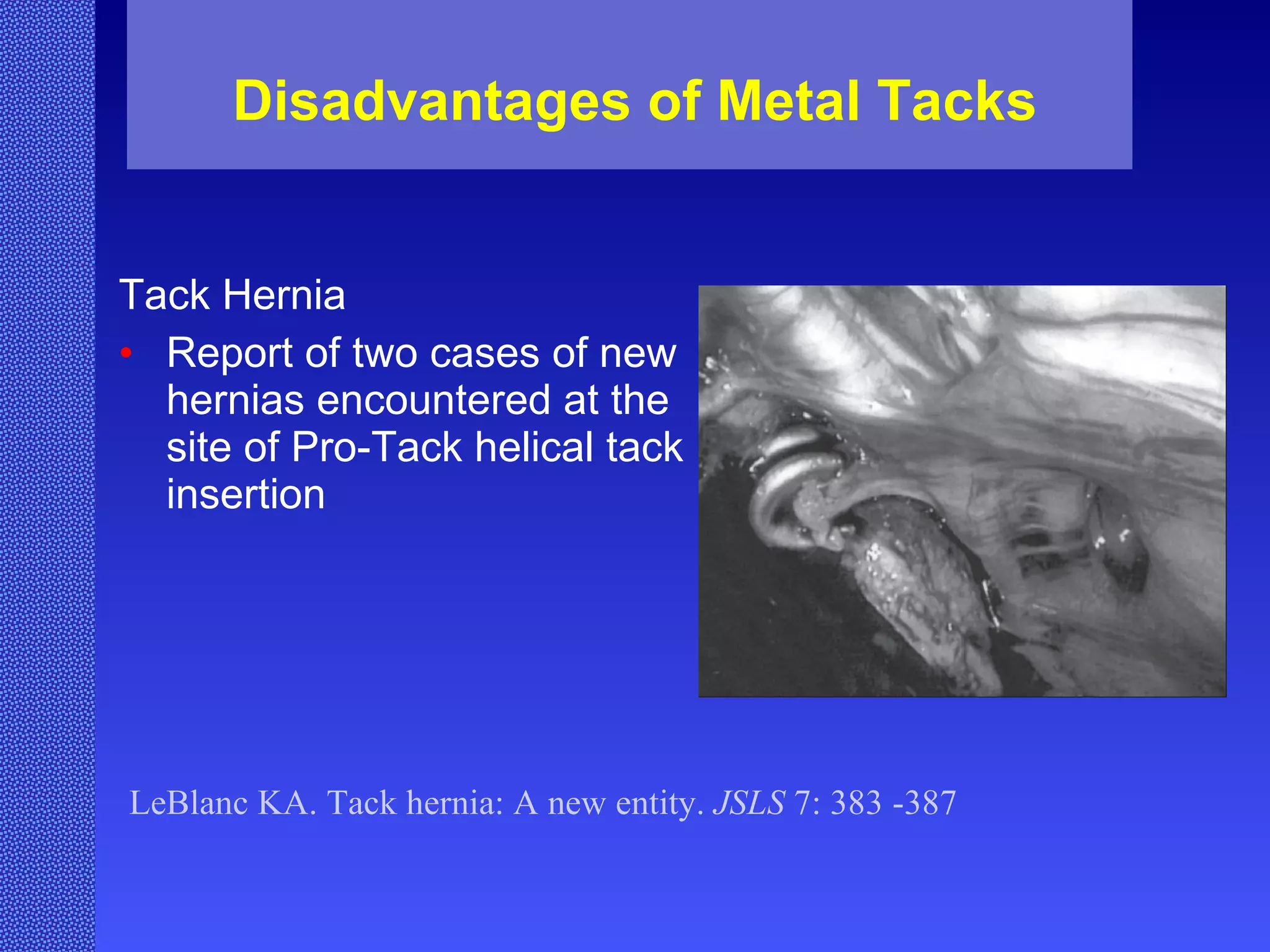 Disadvantages of Metal Tacks Tack Hernia  Report of two cases of new hernias encountered at the site of Pro-Tack helical tack insertion LeBlanc KA. Tack hernia: A new entity.  JSLS  7: 383 -387 
