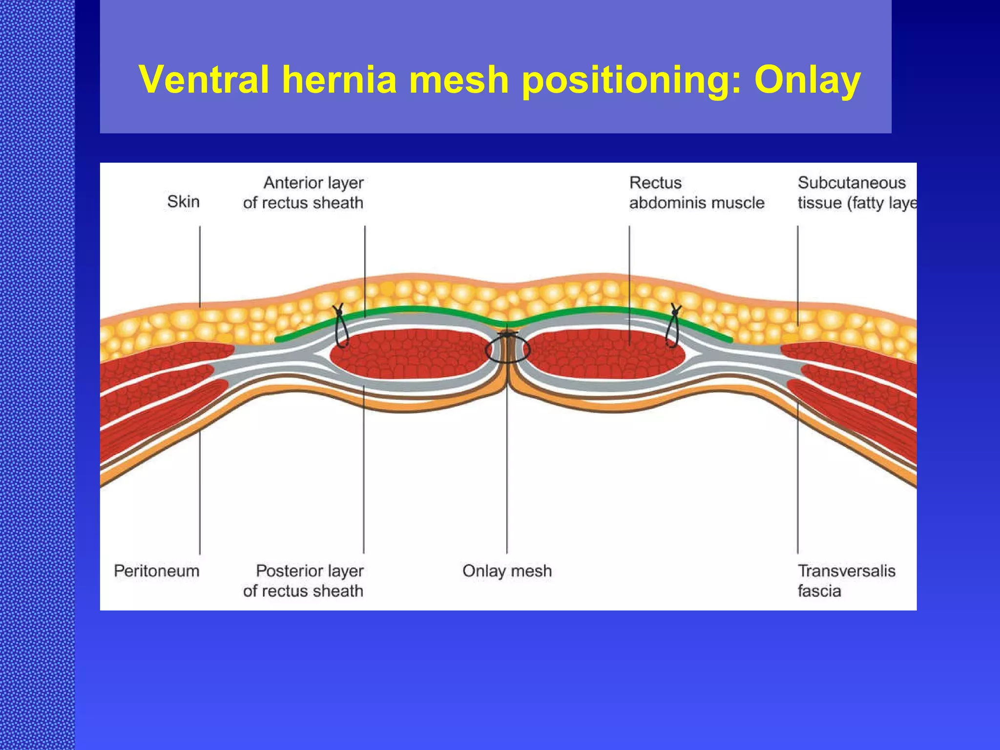 Ventral hernia mesh positioning: Onlay 