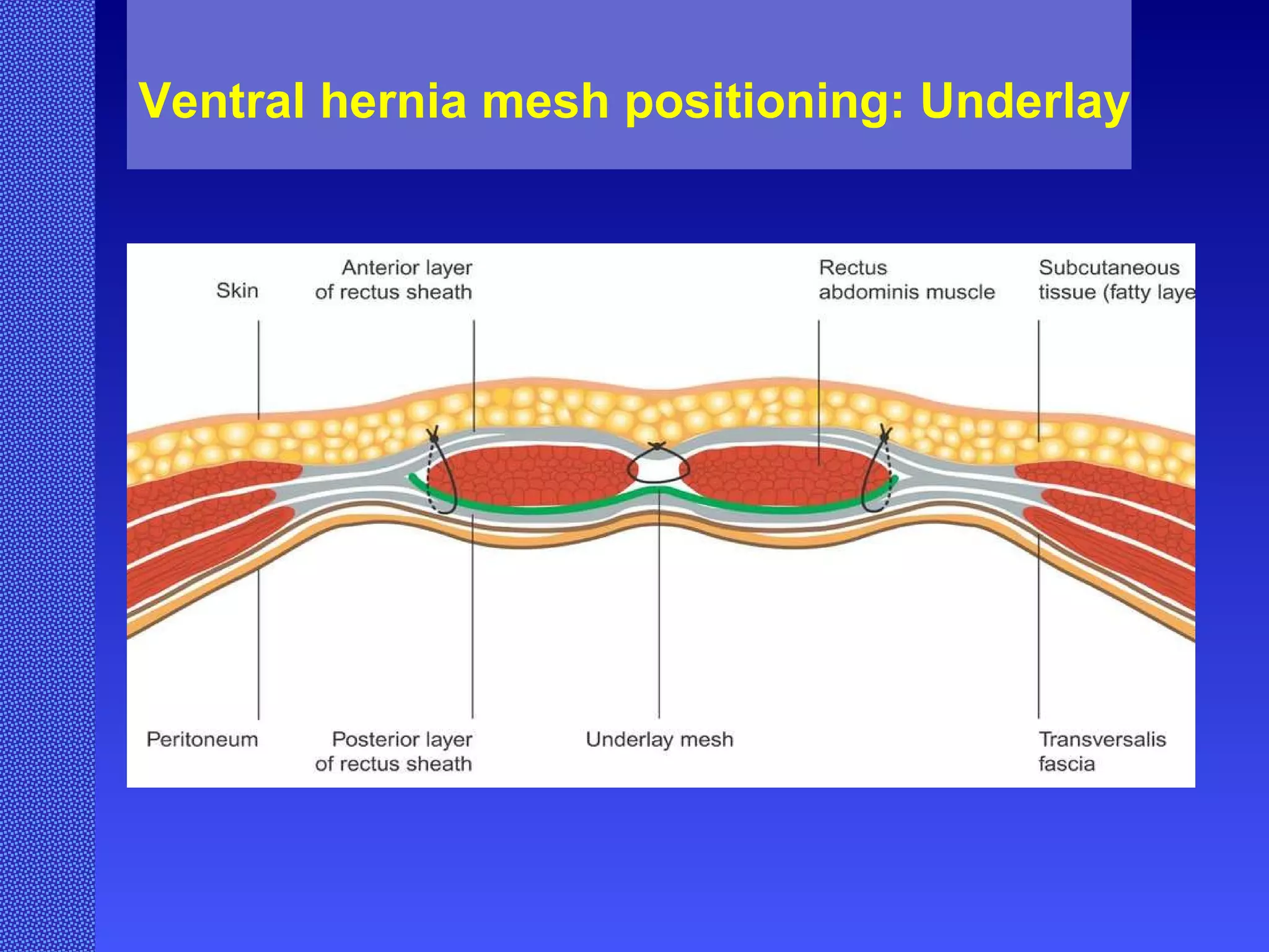 Ventral hernia mesh positioning: Underlay 