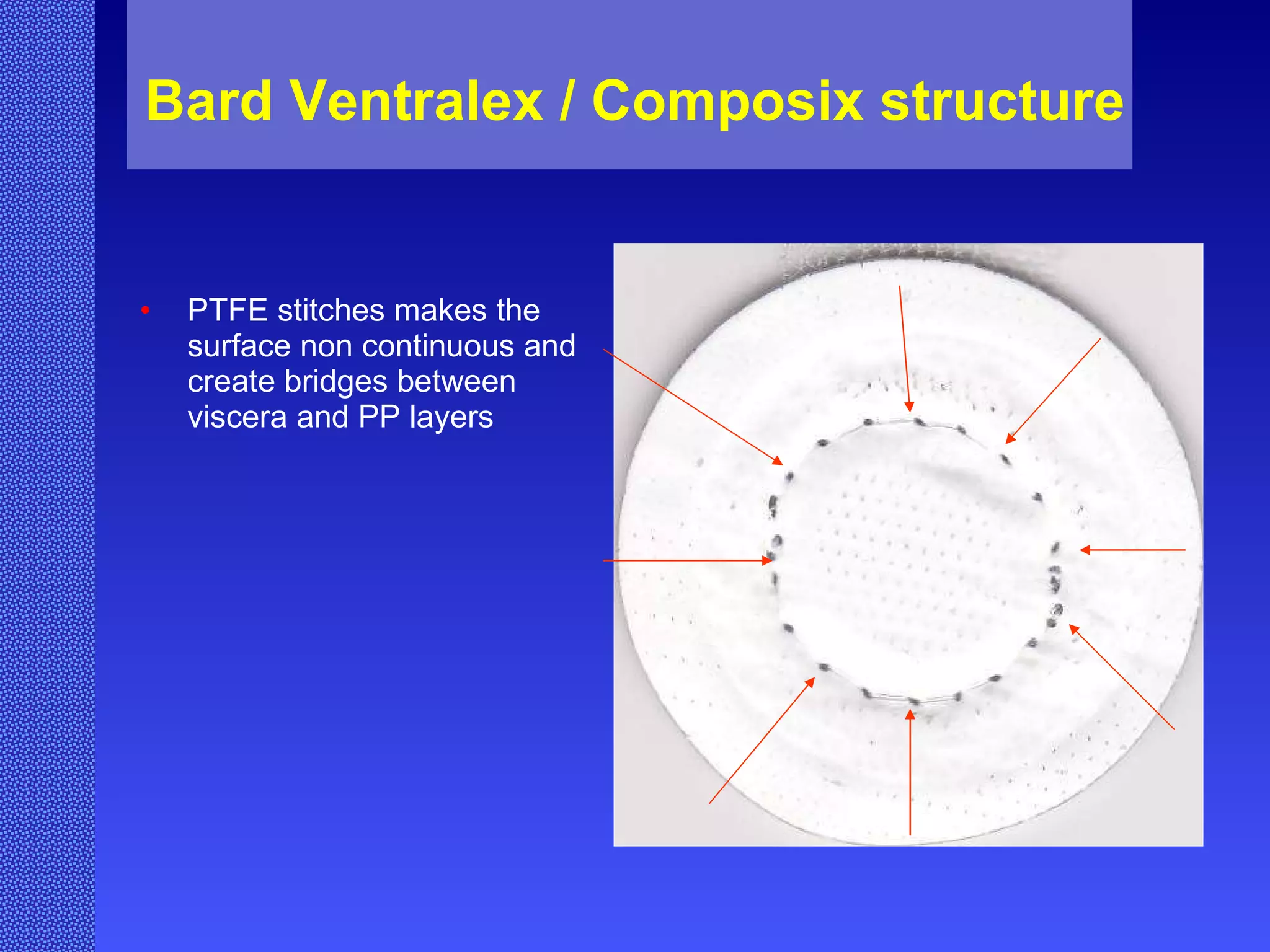 Bard Ventralex / Composix structure PTFE stitches makes the surface non continuous and create bridges between viscera and PP layers 