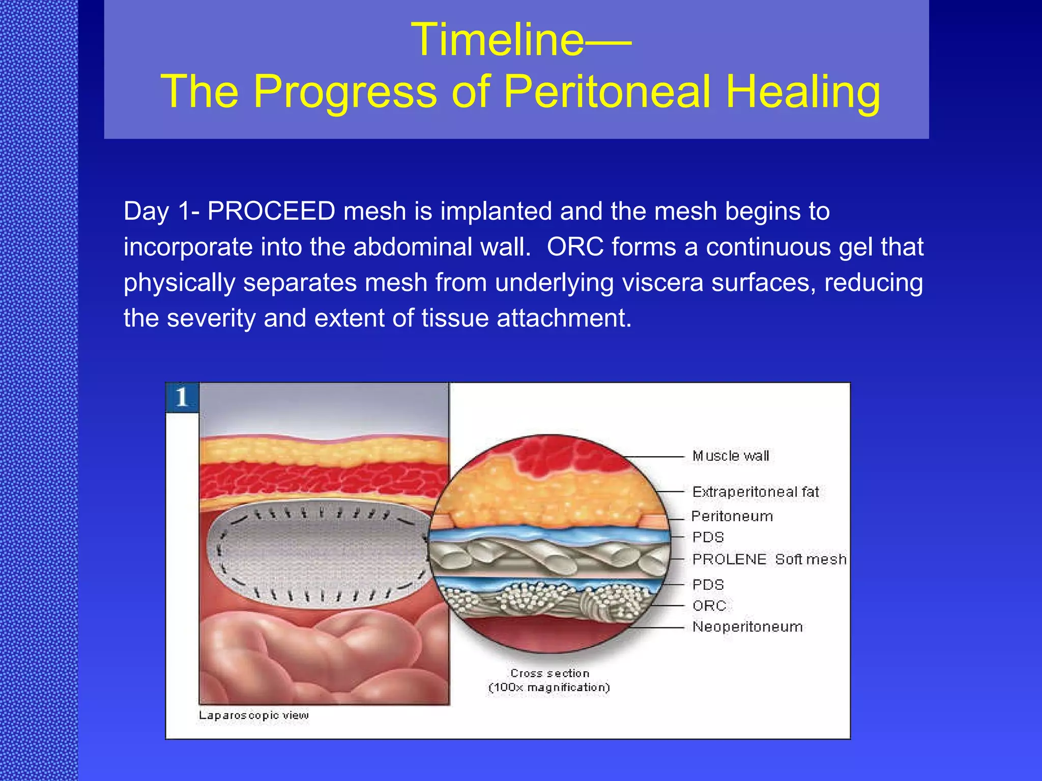 Timeline— The Progress of Peritoneal Healing Day 1- PROCEED mesh is implanted and the mesh begins to  incorporate into the abdominal wall.  ORC forms a continuous gel that  physically separates mesh from underlying viscera surfaces, reducing  the severity and extent of tissue attachment.  