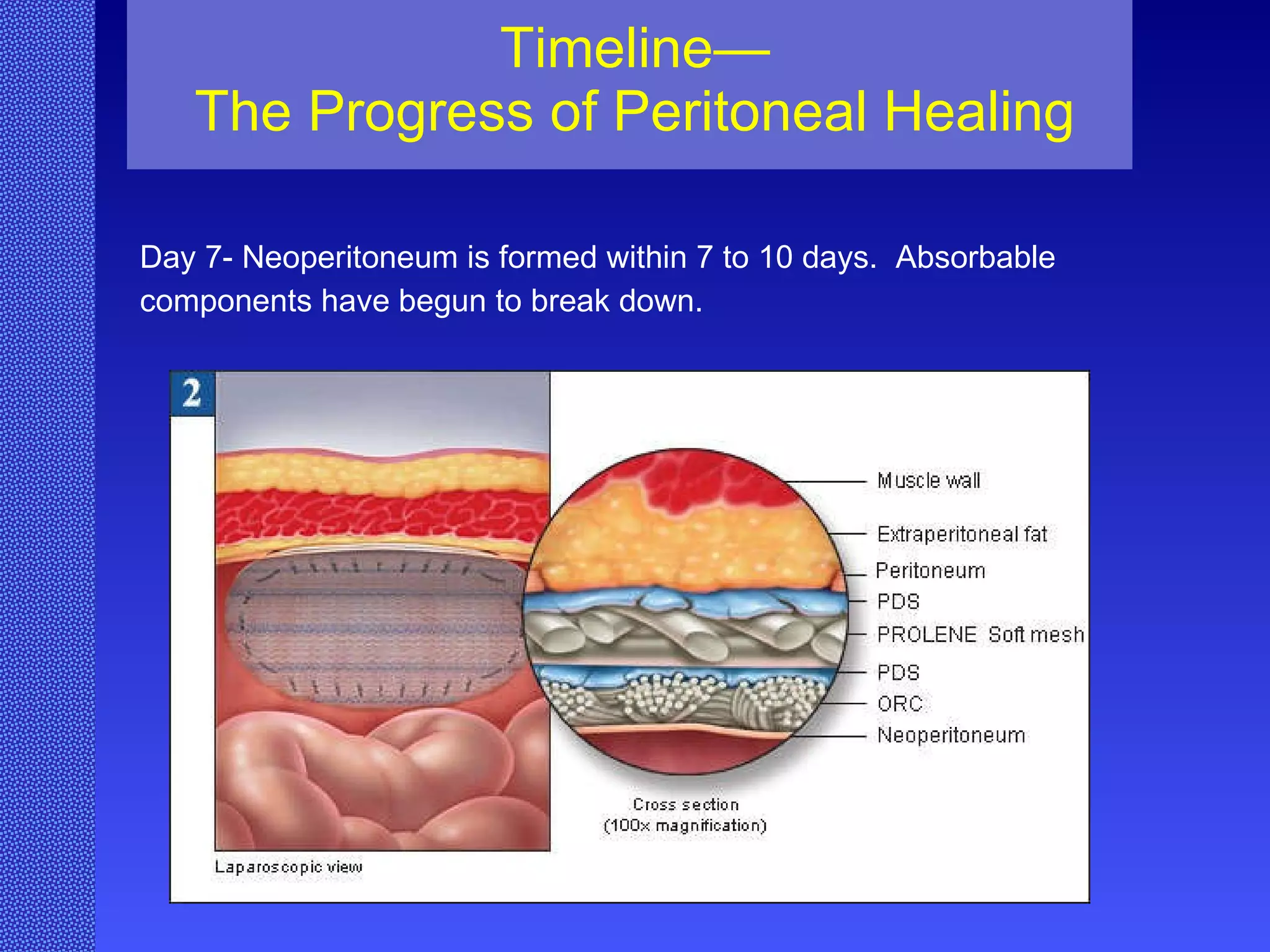 Timeline— The Progress of Peritoneal Healing Day 7- Neoperitoneum is formed within 7 to 10 days.  Absorbable  components have begun to break down. 