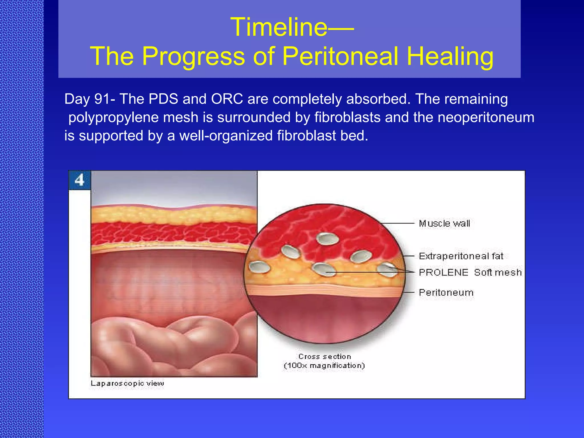 Timeline— The Progress of Peritoneal Healing Day 91- The PDS and ORC are completely absorbed. The remaining polypropylene mesh is surrounded by fibroblasts and the neoperitoneum  is supported by a well-organized fibroblast bed. 