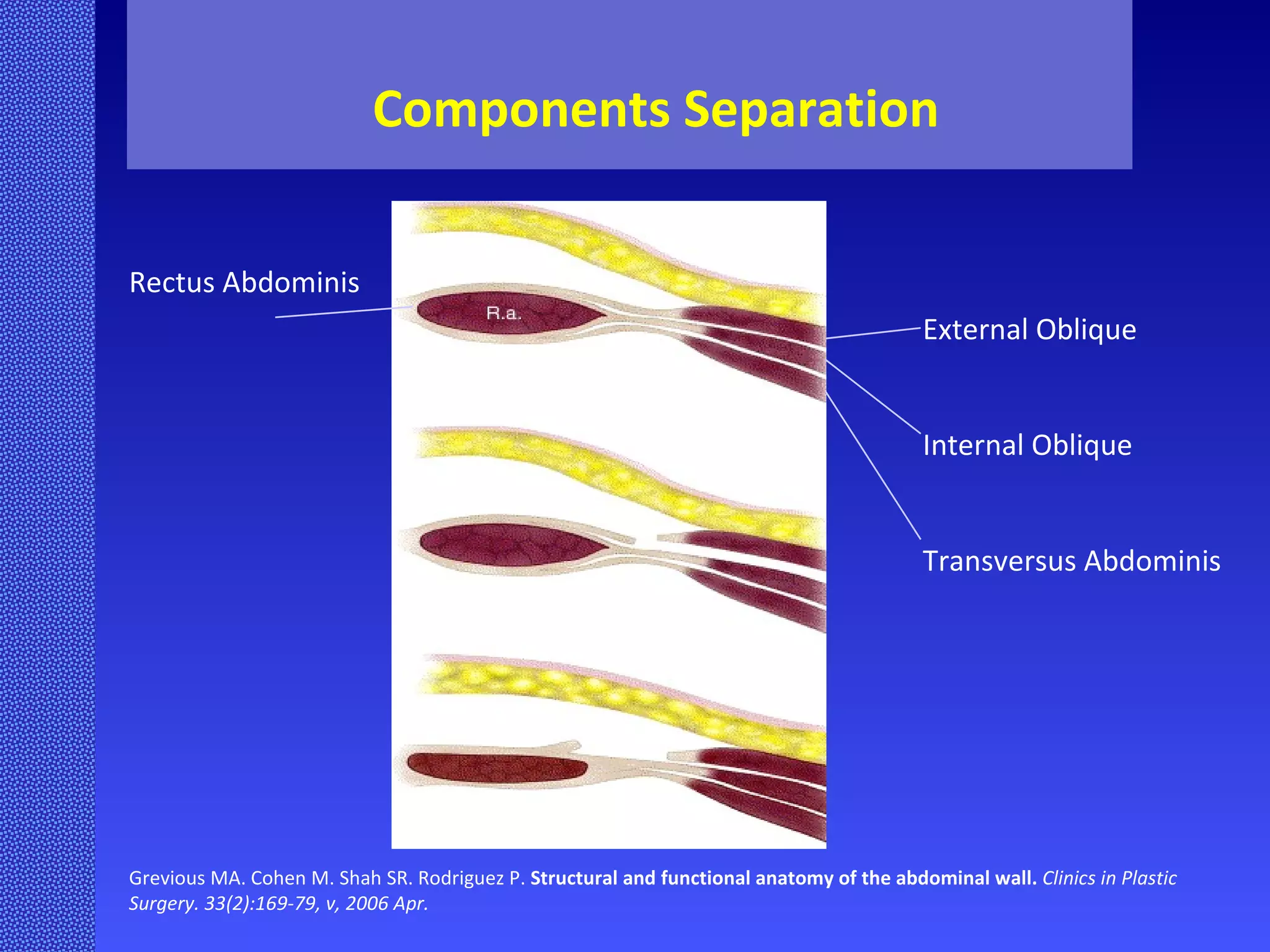 Grevious MA. Cohen M. Shah SR. Rodriguez P.  Structural and functional anatomy of the abdominal wall.   Clinics in Plastic Surgery. 33(2):169-79, v, 2006 Apr. External Oblique Internal Oblique Transversus Abdominis Rectus Abdominis Components Separation 