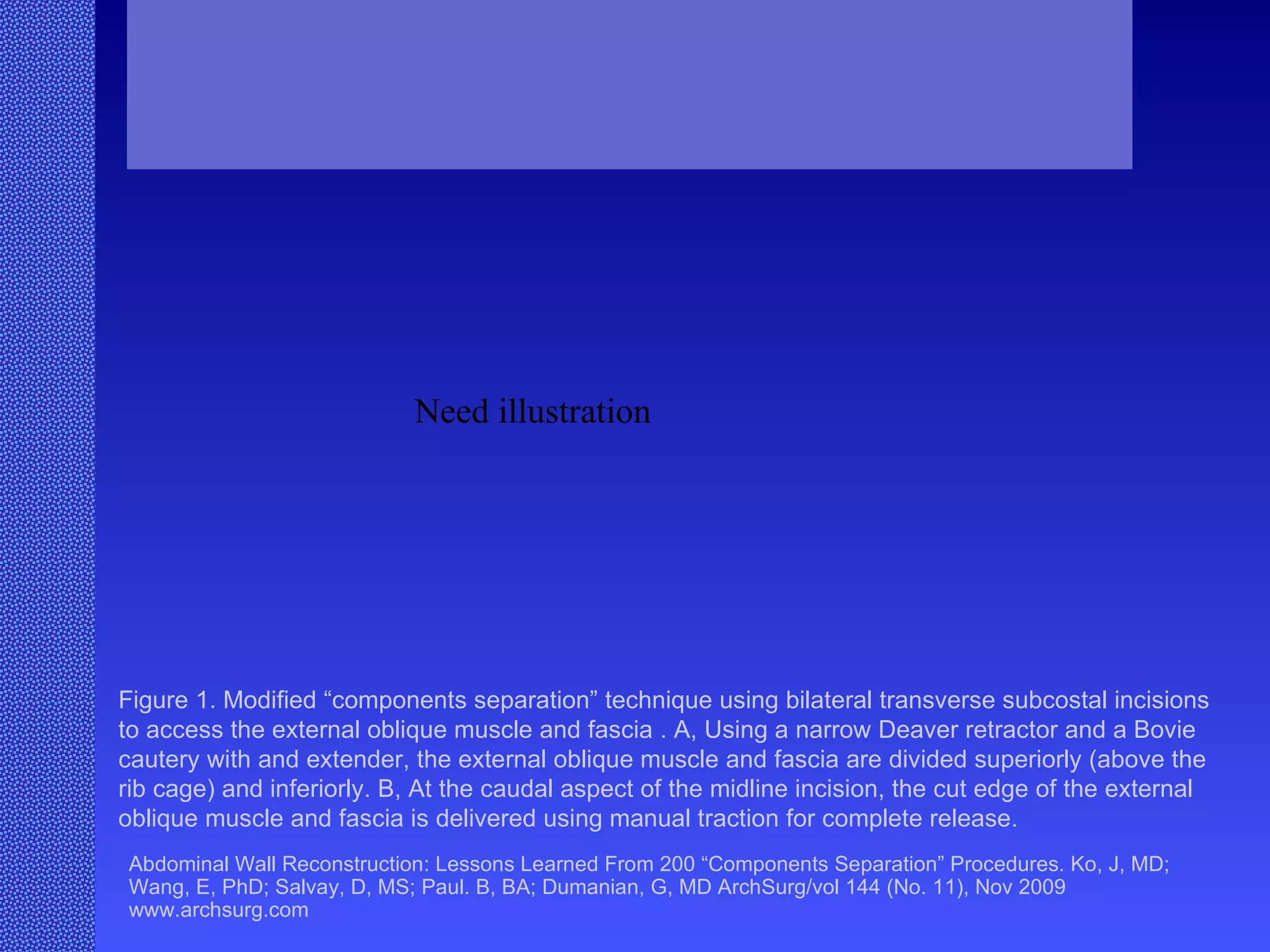 Abdominal Wall Reconstruction: Lessons Learned From 200 “Components Separation” Procedures. Ko, J, MD; Wang, E, PhD; Salvay, D, MS; Paul. B, BA; Dumanian, G, MD ArchSurg/vol 144 (No. 11), Nov 2009  www.archsurg.com Figure 1. Modified “components separation” technique using bilateral transverse subcostal incisions to access the external oblique muscle and fascia . A, Using a narrow Deaver retractor and a Bovie cautery with and extender, the external oblique muscle and fascia are divided superiorly (above the rib cage) and inferiorly. B, At the caudal aspect of the midline incision, the cut edge of the external oblique muscle and fascia is delivered using manual traction for complete release. Need illustration 