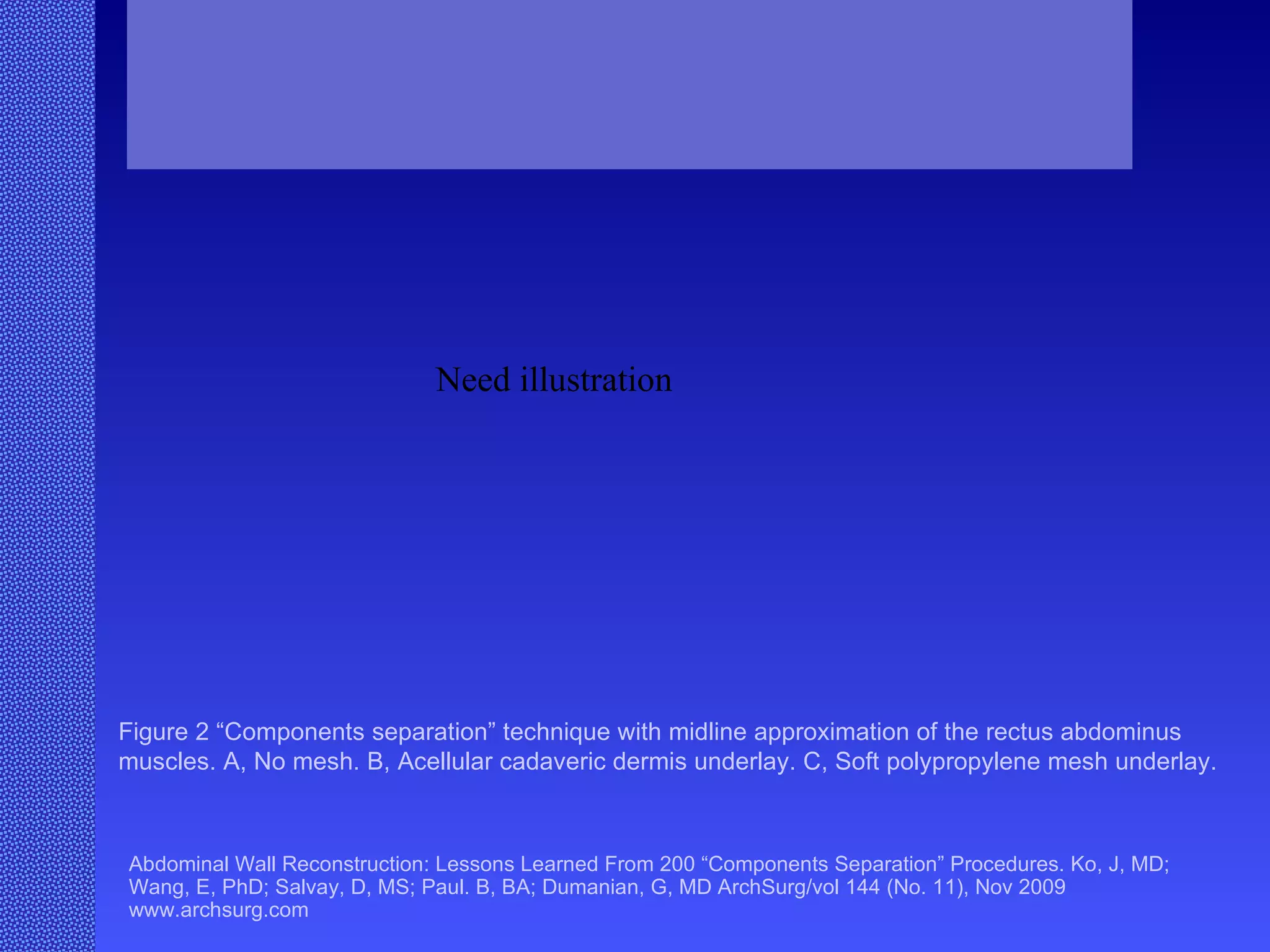 Abdominal Wall Reconstruction: Lessons Learned From 200 “Components Separation” Procedures. Ko, J, MD; Wang, E, PhD; Salvay, D, MS; Paul. B, BA; Dumanian, G, MD ArchSurg/vol 144 (No. 11), Nov 2009  www.archsurg.com Figure 2 “Components separation” technique with midline approximation of the rectus abdominus muscles. A, No mesh. B, Acellular cadaveric dermis underlay. C, Soft polypropylene mesh underlay.  Need illustration 