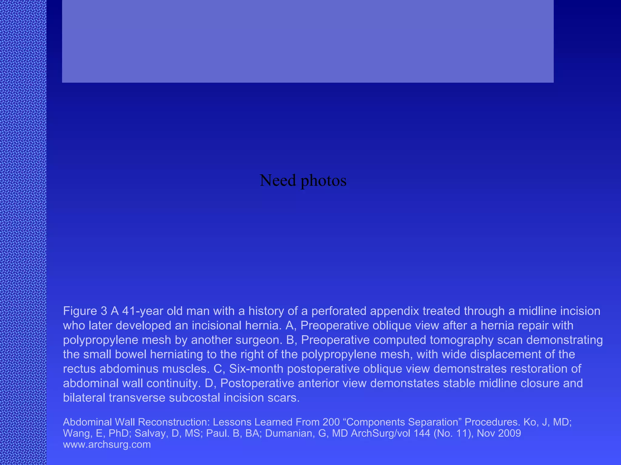 Abdominal Wall Reconstruction: Lessons Learned From 200 “Components Separation” Procedures. Ko, J, MD; Wang, E, PhD; Salvay, D, MS; Paul. B, BA; Dumanian, G, MD ArchSurg/vol 144 (No. 11), Nov 2009  www.archsurg.com Figure 3 A 41-year old man with a history of a perforated appendix treated through a midline incision who later developed an incisional hernia. A, Preoperative oblique view after a hernia repair with polypropylene mesh by another surgeon. B, Preoperative computed tomography scan demonstrating the small bowel herniating to the right of the polypropylene mesh, with wide displacement of the rectus abdominus muscles. C, Six-month postoperative oblique view demonstrates restoration of abdominal wall continuity. D, Postoperative anterior view demonstates stable midline closure and bilateral transverse subcostal incision scars.  Need photos 