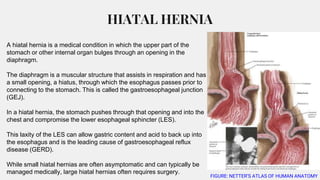 Surgical Management of GERD & Hiatal Hernia | PPTX