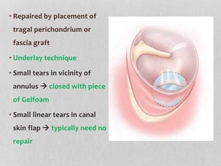 Tragal Surgical mx of otosclerosis | PPTX