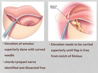 • Elevation of annulus
superiorly done with curved
needle
• chorda tympani nerve
identified and dissected free
• Elevation...