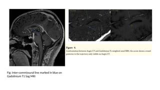 Surgical management of Parkinson's disease- | PPTX