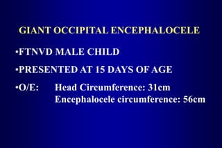 GIANT OCCIPITAL ENCEPHALOCELE
•FTNVD MALE CHILD
•PRESENTED AT 15 DAYS OF AGE
•O/E: Head Circumference: 31cm
Encephalocele circumference: 56cm
 