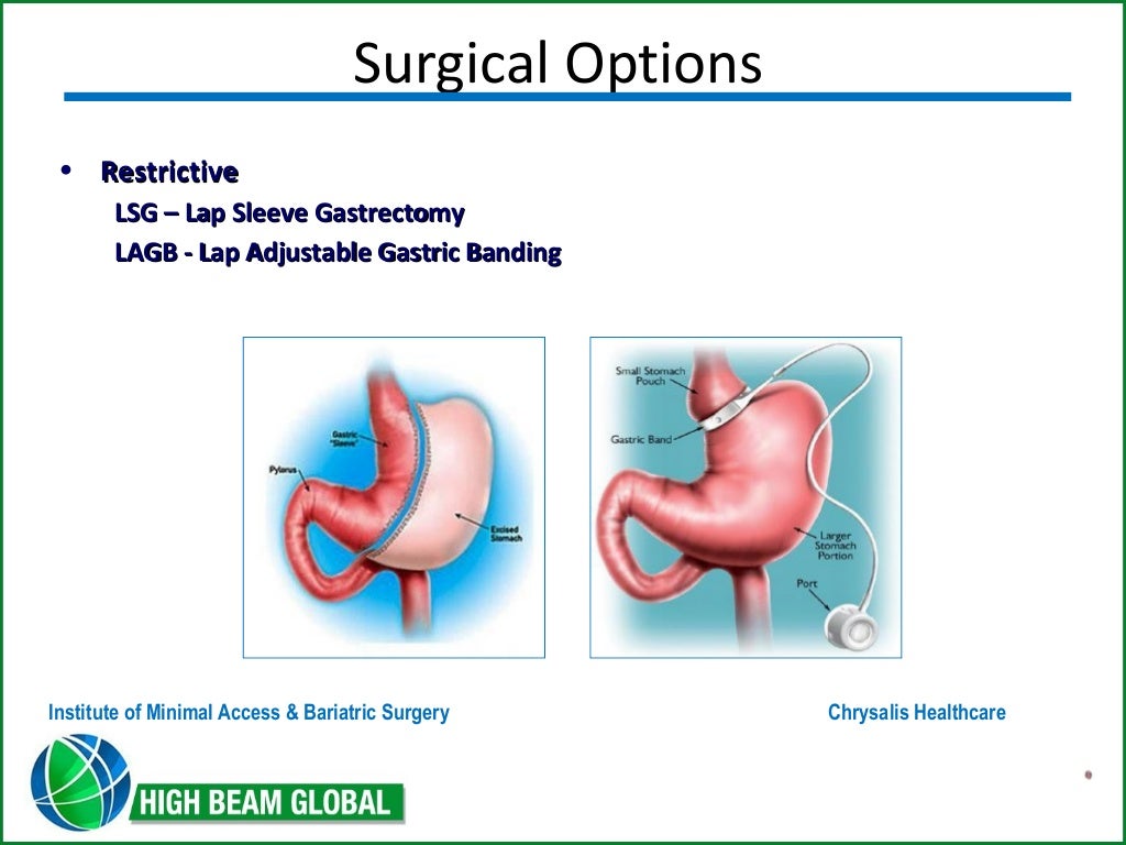 Surgical options for morbid obesity