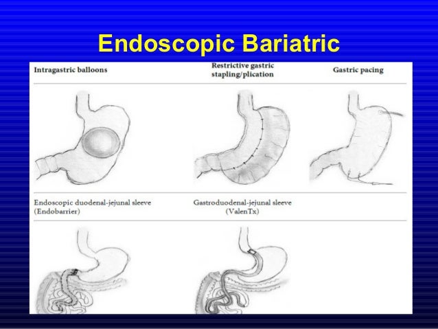 Bariatric Surgery