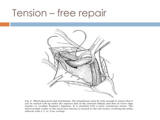 Totally extraperitoneally
   The first TEP inguinal hernia repair was
    described by McKernan and Laws in1993.

   Thi...