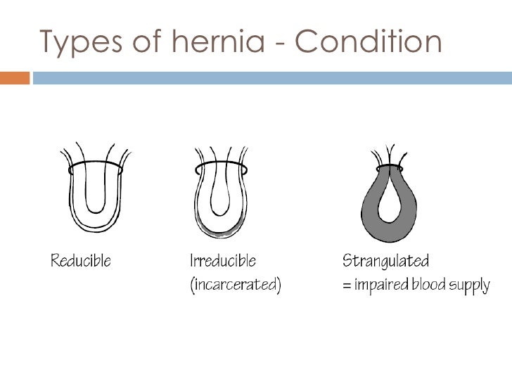Surgical Options In The Management Of Hernia Repair