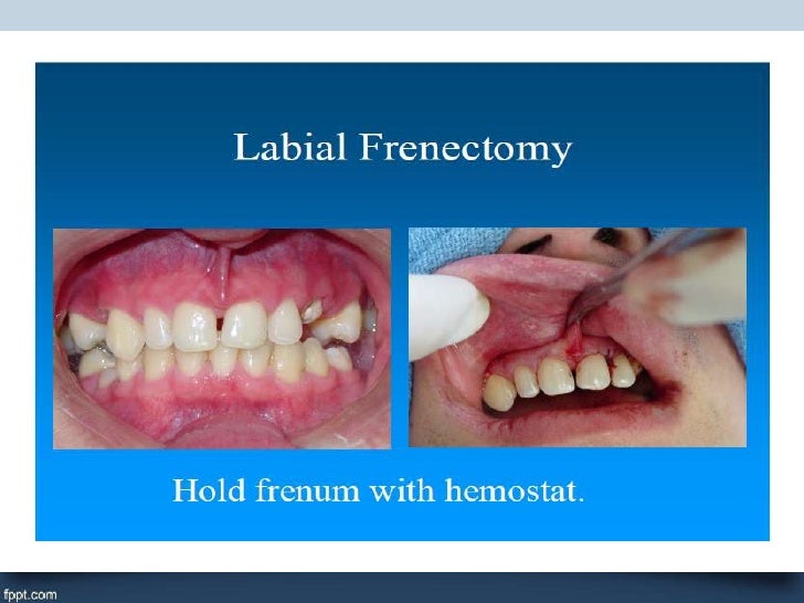 Surgical orthodonticsminor surgical procedures