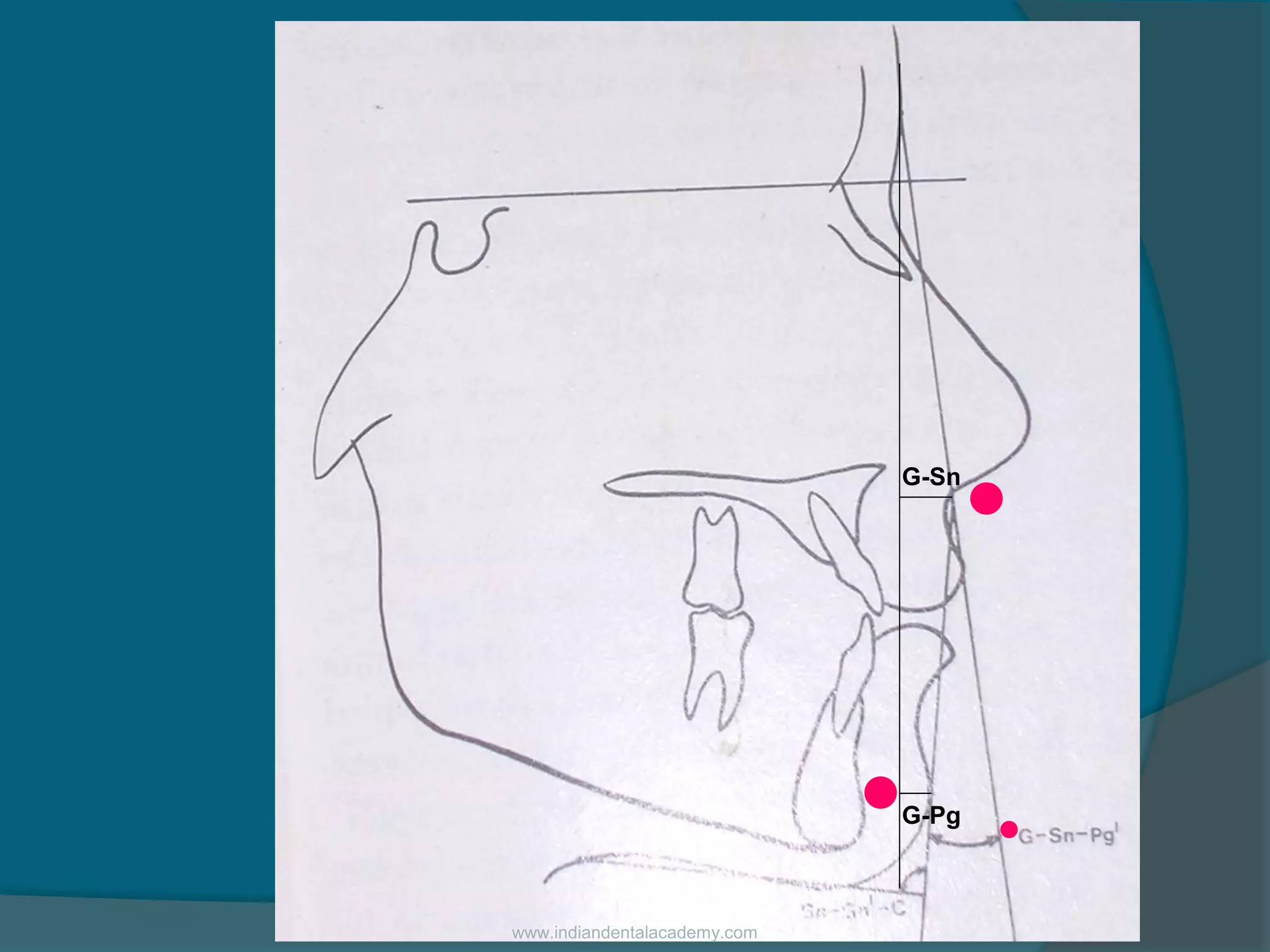 G-Sn
G-Pg
.
. .
www.indiandentalacademy.com
 