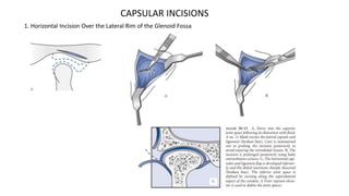Lateral Utility Incision surgical part.pptx