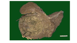 Surgical pathology of hepatobiliary tree and pancreas | PPTX