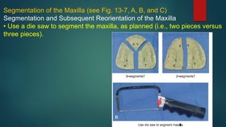 Segmentation of the Maxilla (see Fig. 13-7, A, B, and C)
Segmentation and Subsequent Reorientation of the Maxilla
• Use a die saw to segment the maxilla, as planned (i.e., two pieces versus
three pieces).
 