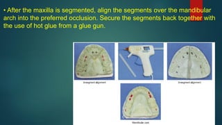 • After the maxilla is segmented, align the segments over the mandibular
arch into the preferred occlusion. Secure the segments back together with
the use of hot glue from a glue gun.
 